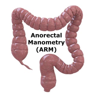 Anorectal Manometry and Care Paths that Leverage Anorectal Manometry
