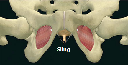 Incontinence Bladder Sling.png