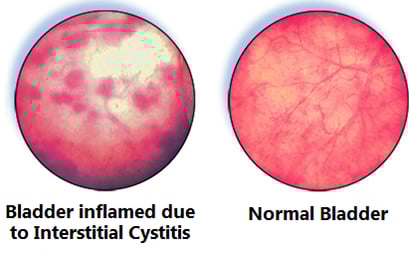 cystitis interstitial bladder ic urodynamics ulcerative