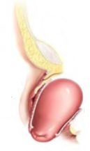 Pelvic Organ Prolapse and Urodynamics