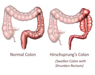 hirschsprung and anorectal manometry