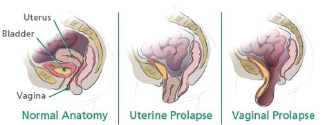 prolapse