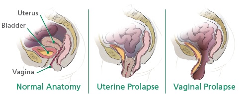 bladder prolapse sling